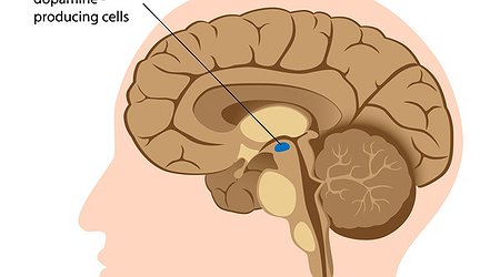 Laughter Yoga Reduces Anxiety & Improves Sleep In Parkinson Patients